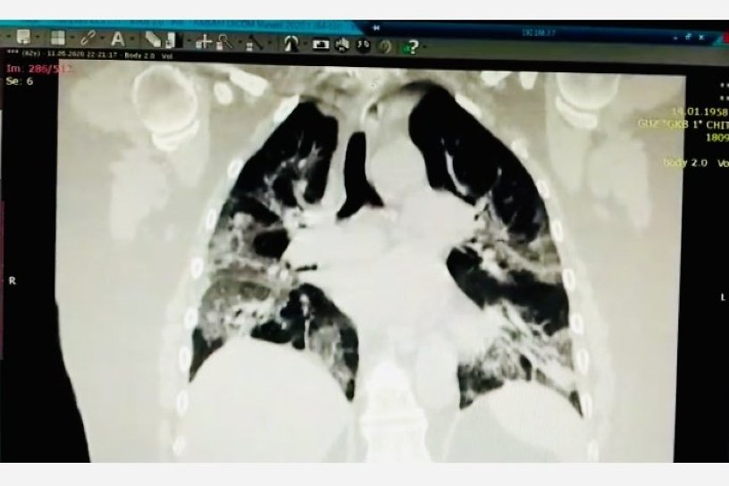 Количество пациентов с внебольничной пневмонией в Приангарье за 2,5 недели выросло на 33%